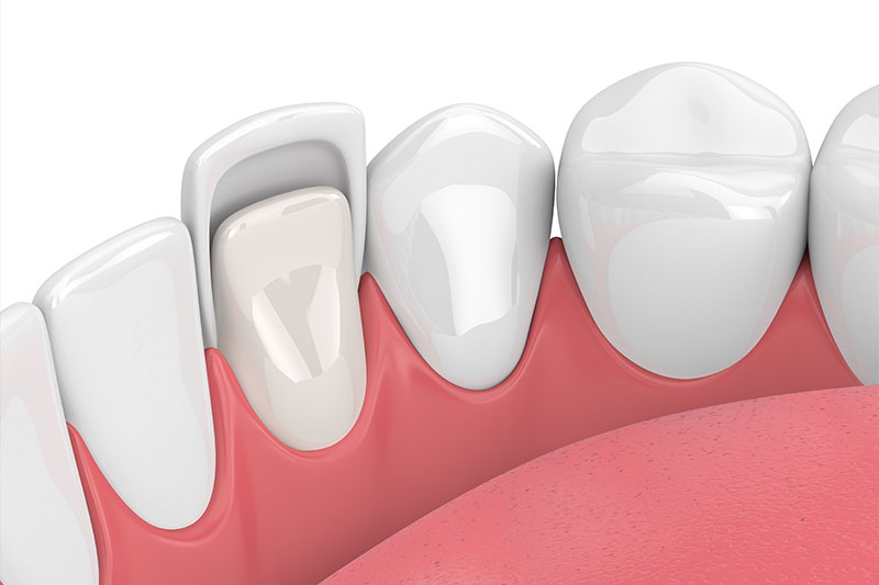 Porcelain Veneers in Burke